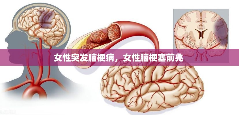 女性突发脑梗病,女性脑梗塞前兆