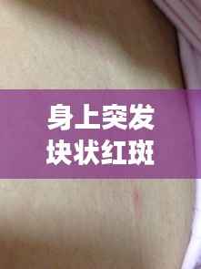 身上突发块状红斑,身上突然出现大块红斑,很痒是怎么回事,是过敏么
